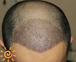 -大麦微针植发丨全国连锁