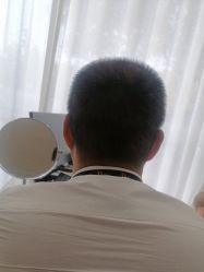 点击看大图 -大麦微针植发丨全国连锁