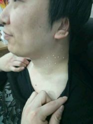 -百年美肤堂祛痦痣祛斑祛疣