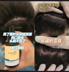 -菩叶脱发白发中心