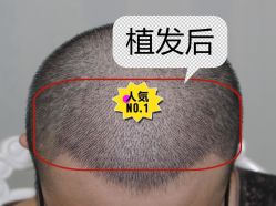 -大麦微针植发全国连锁