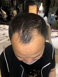 体验前-大麦微针植发全国连锁