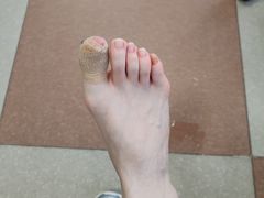 -世龙世家灰指甲鸡眼脚气甲沟炎跖疣护理(通州店)