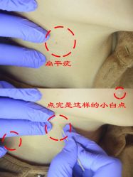 -清疣美疣·痣·斑净肤中心