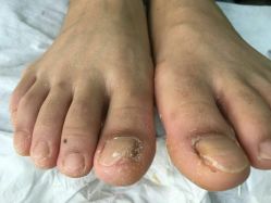 -德哥灰指甲脚气甲沟炎跖疣护理
