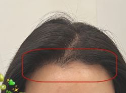 -大麦微针植发全国连锁