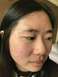 -美丽人生祛斑扁平疣汗管瘤中心
