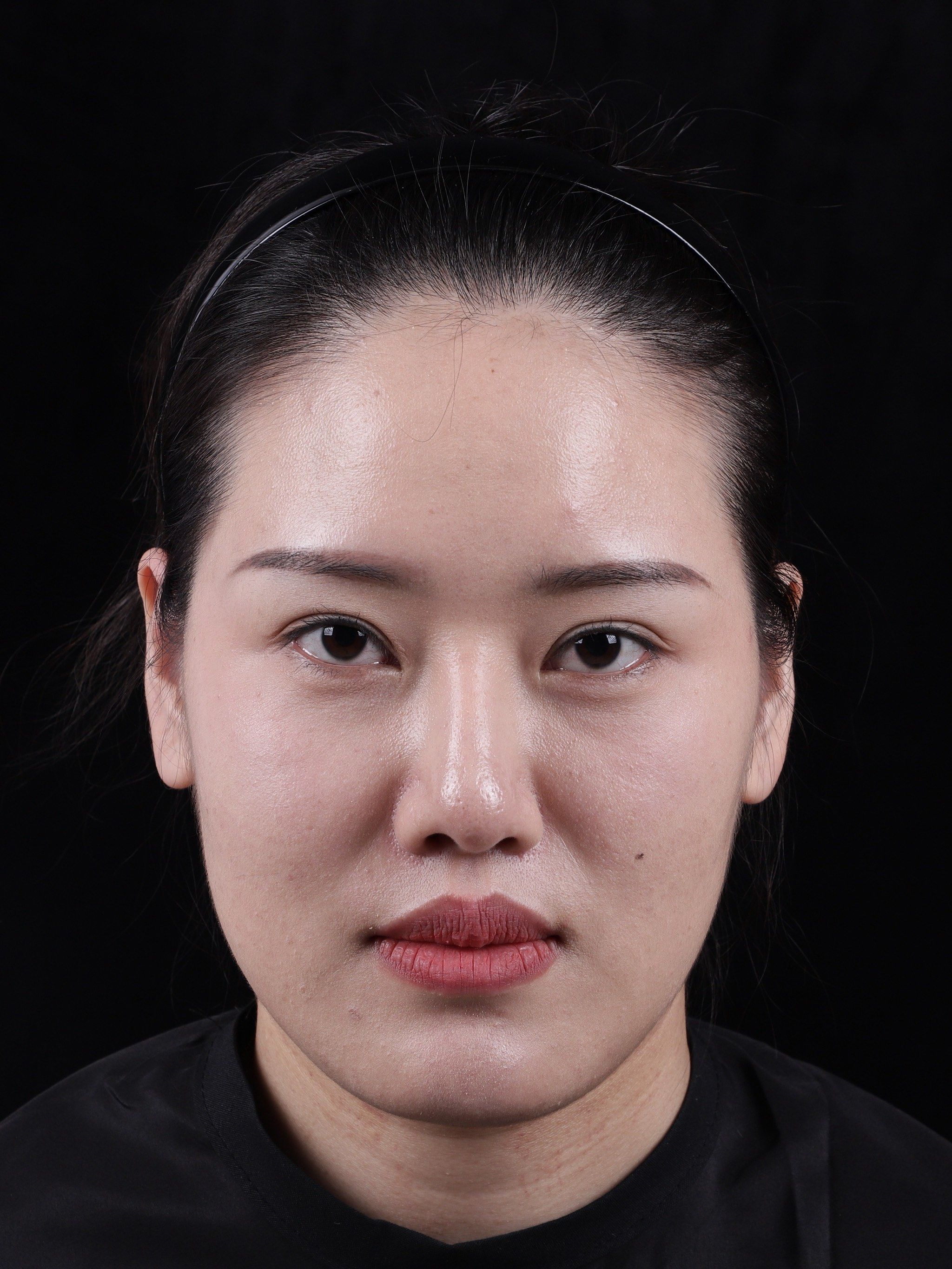 【玻尿酸】体验7天后效果分享