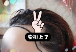 -大麦微针植发全国连锁