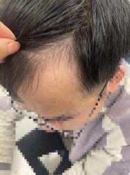 -大麦微针植发全国连锁