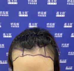 -碧莲盛·不剃发植发