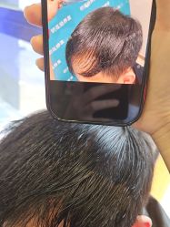 -碧莲盛·不剃发植发