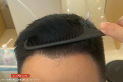 -大麦微针植发丨全国连锁