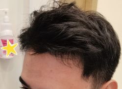 -大麦微针植发丨全国连锁