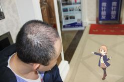 -大麦微针植发丨全国连锁