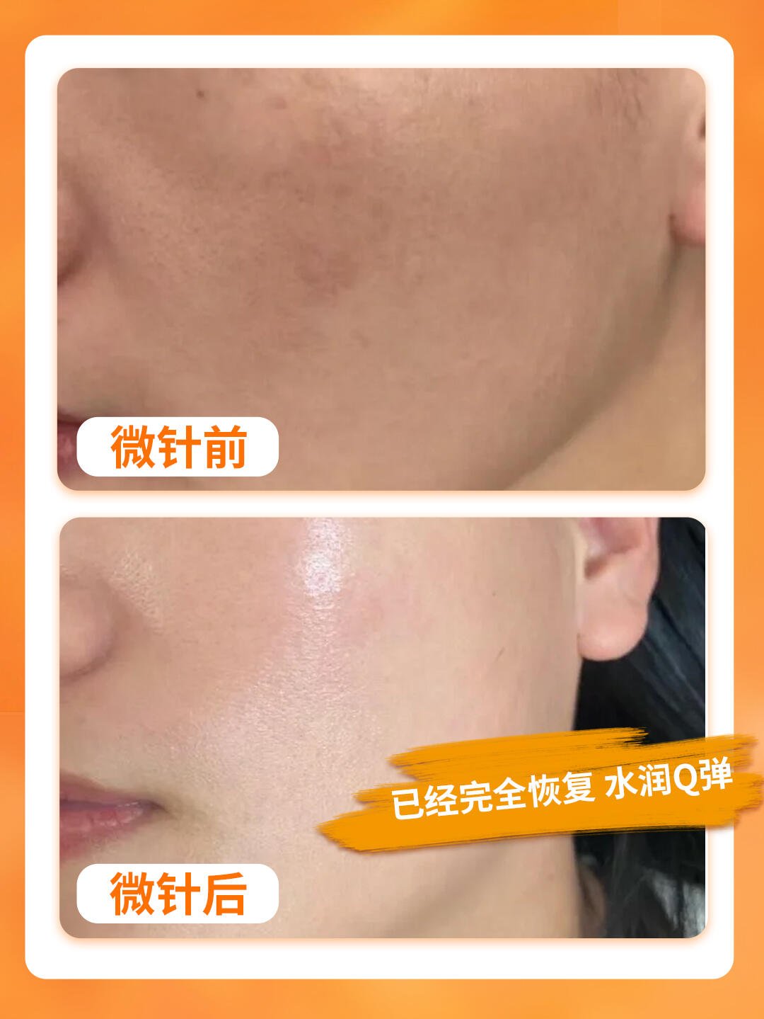 微针射频做一次有效果吗