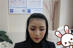 点击看大图 -大麦微针植发丨全国连锁