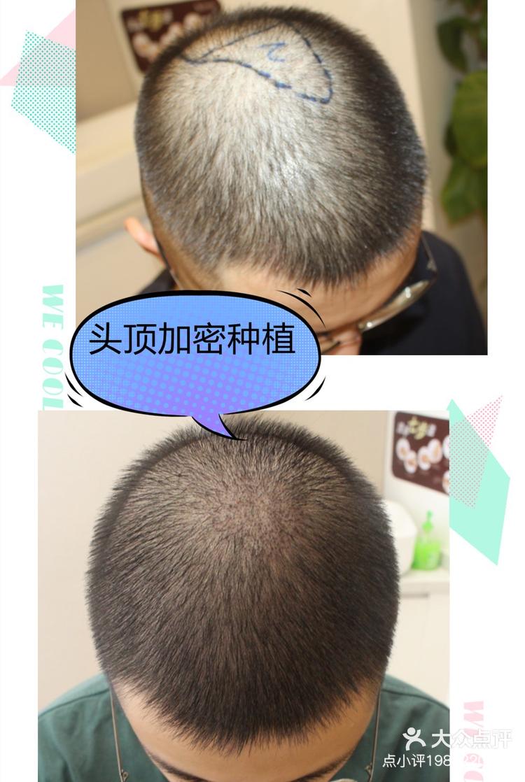 现在头顶的头发密度很理想