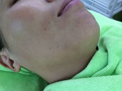 -苗医生草本科技祛痘