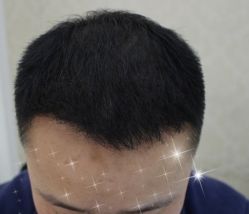 -大麦微针植发全国连锁