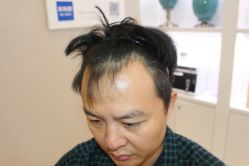 -大麦微针植发丨全国连锁