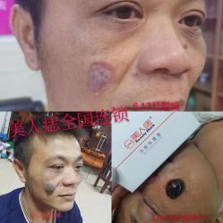 -美人痣全国连锁