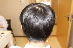 -大麦微针植发丨全国连锁