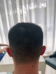 -大麦微针植发丨全国连锁