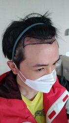 -大麦微针植发丨全国连锁