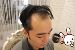 -大麦微针植发丨全国连锁