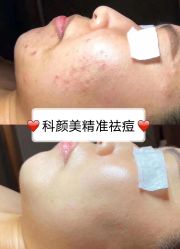 -美肤盾祛痘·问题肌头疗管理中心