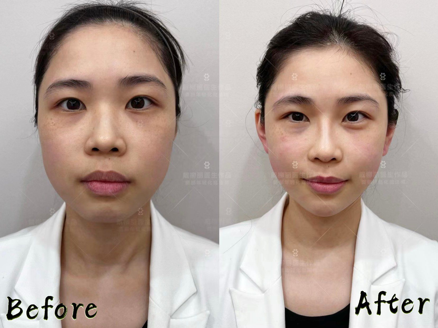 精灵耳注射即刻对比,脸小了一圈