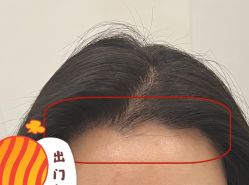 -大麦微针植发全国连锁