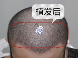 -大麦微针植发全国连锁