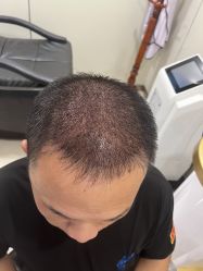 体验后-碧莲盛·不剃发植发