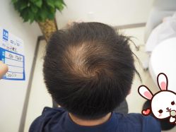 -大麦微针植发丨全国连锁