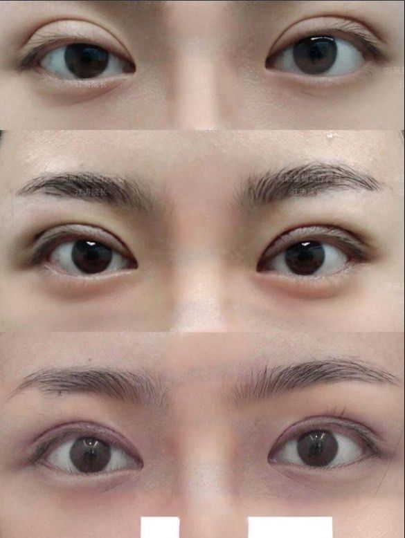 小姐姐2米宽欧式大平行,改成窄扇形双眼皮,美呆了