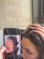 -碧莲盛·不剃发植发