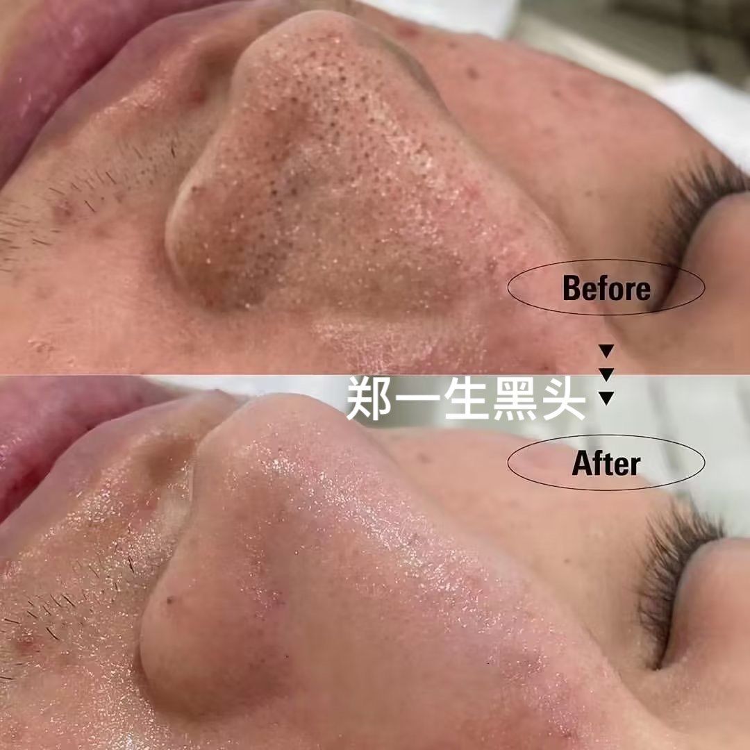 黑头操作前后对比