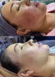 -瑶芳清颜草本祛痘