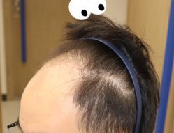 -大麦微针植发全国连锁