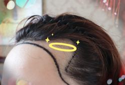 -大麦微针植发全国连锁