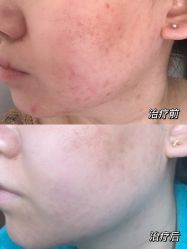 体验前-亿美医疗美容·半岛大超炮官方授权店