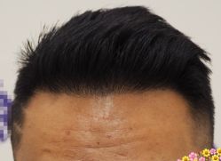 -大麦微针植发全国连锁