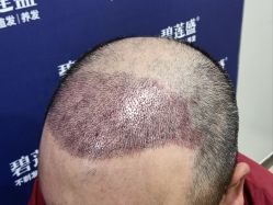 -碧莲盛·不剃发植发