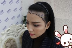 -大麦微针植发丨全国连锁