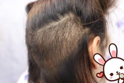 -大麦微针植发丨全国连锁