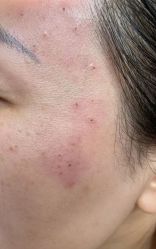 -痣斑堂·取大痣