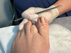 -世龙世家灰指甲鸡眼脚气甲沟炎跖疣护理(通州店)