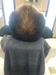 点击看大图 -大麦微针植发丨全国连锁